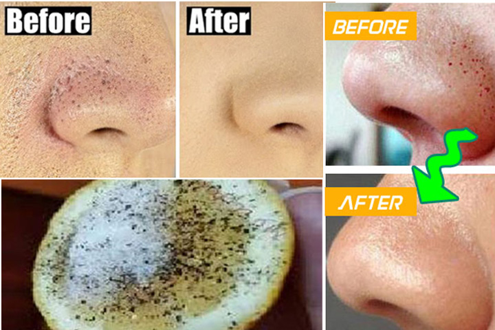 Blackheads